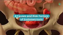 4 Causes and Risk Factors of Endometriosis