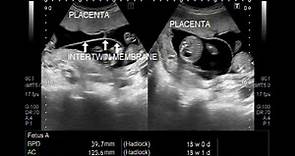 Triplet Pregnancy of about 18 weeks on Ultrasound.