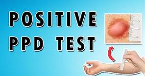Positive PPD Test