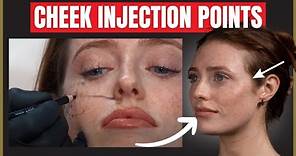 The Best Cheek Filler Injection Points | Where to inject the cheek for beautiful results.