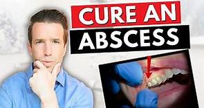 Dentist Explains a Tooth Abscess | How to Cure an Abscess Tooth