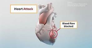 The differences between heart attack and cardiac arrest