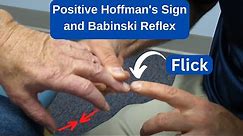 Positive Hoffman's Sign and Babinski Reflex in an MS Patient