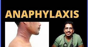 Anaphylaxis! (Causes, Clinical features, Management)