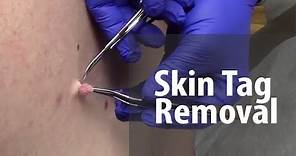 Skin Tag Removal | Dr. Derm