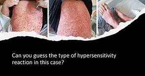 Morbilliform rash | Can you diagnose this case?