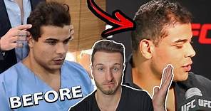Paulo Costa Hair Transplant Result Evaluation after 4 Months! #Shock Loss!?