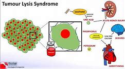 Tumour Lysis Syndrome