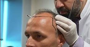 Gordon Schildenfeld Hair Transplant Journey | Dr.Cinik Hospital
