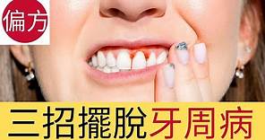 三招解決牙周病｜牙齦發炎，流牙血問題