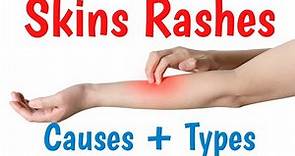 Skin Rash | Causes, Symptoms, Types & Diagnosis |