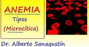 Anemias (1): síntomas y tipos | Anemia Microcítica