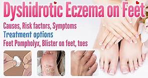 Dyshidrotic eczema on feet causes, symptoms, risk factors, treatment options, Feet pompholyx blister