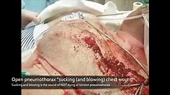 A sucking (and blowing) chest wound is the sound of not dying