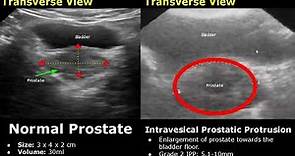 Prostate Ultrasound Normal Vs Abnormal Image Appearances | Transrectal (TRUS) & Transabdominal USG