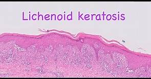 Lichenoid keratosis