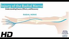 Radial Nerve Injury: What You Need to Know