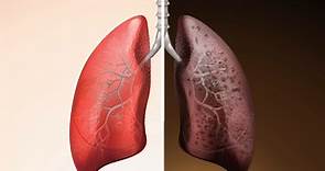 Ecco come diventano i polmoni di un fumatore