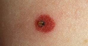 How to Spot Lyme Disease | WebMD