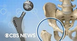 CBS News investigation details reports of broken hip implants
