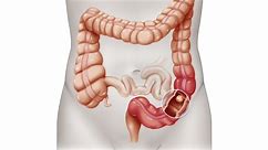 Colorectal cancer: What you need to know