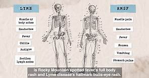 Medical Minute: Rocky Mountain Spotted Fever & Lyme Disease