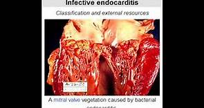 Bacterial Endocarditis - Splinter hemorrhages in fingernails
