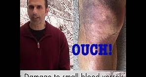 Hematoma: leg bruising and swelling