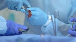 Operating Doctor Resecting Tumor Putting Organ Part in Surgical Tray, Histology