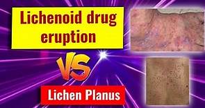 Lichenoid drug eruption: features and comparison with lichen planus