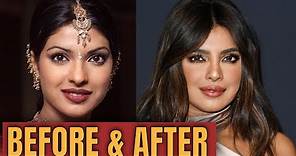 Priyanka Chopra; Plastic (Cosmetic ) Surgery 2020