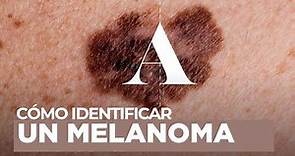 Melanoma: qué es y cómo identificarlo