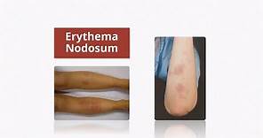 Erythema Nodosum - Causes & Treatment