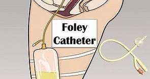 Foley Catheter - Indications, Parts & Their Functions, Risks & Complications