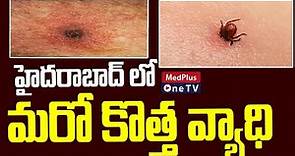Scrub Typhus | New Disease in Hyderabad | @MedPlusONETV