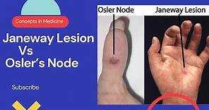 Janeway Lesions Vs Osler's Nodes (Simplified Approach)