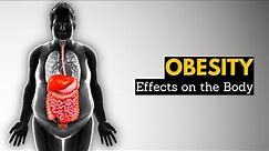 Obesity, Causes, SIgns and Symptoms, Diagnosis and Treatment.
