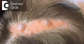 What causes Sebaceous Cyst on the scalp? - Dr. Nischal K