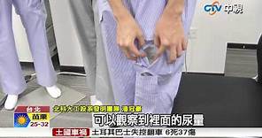 【中視新聞】北科大"尿袋隱藏褲" 病患出門不害羞 20150715