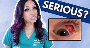 Blood In The Eye? Eye Doctor Explains