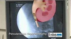 Percutaneous Nephrolithotomy Urology Centers of Alabama