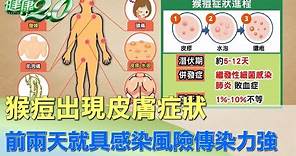 傳染力強！猴痘出現皮膚症狀 前兩天就具感染風險 健康2.0