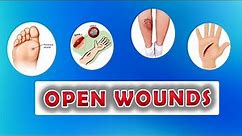 Types of Open Wounds (Abrasion, Laceration, Skin Avulsion, Puntured wounds)
