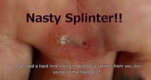 How to Remove a Splinter? Nasty Sliver Removal Hack - DUROX Tweezers