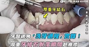【牙醫師視角「洗牙過程」實錄 厚重牙結石脫落瞬間超療癒！】｜@JH_dentist