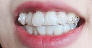 【透明牙套隐适美整牙】真的那么神么?巨详细加拿大Invisalign一周记录 | 挑选医生|3D建模过程| 牙套清洁护牙流程 |佩戴感受| 价格