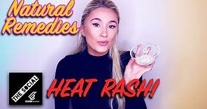 How To Get Rid Of Heat Rash | Natural Remedies