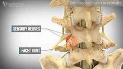 Endoscopic Facet Rhizotomy | Spine Institute of North America