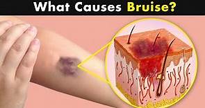 Bruises - Why does it happens? | Symptoms, Causes and treatment (Urdu/Hindi)