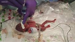 World’s smallest surviving baby born in San Diego